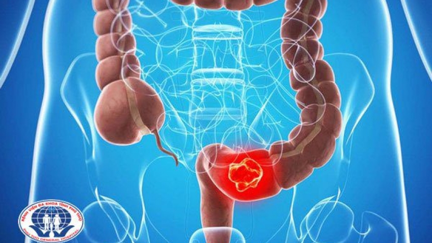 Ung thư trực tràng – Những tín hiệu bị bỏ quên